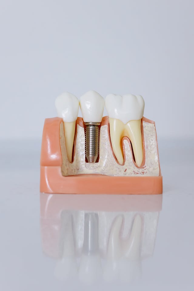 zubní implantát